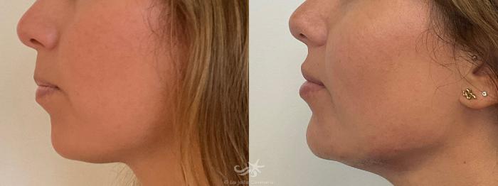Before & After Juvéderm® Voluma™ Result 694 Left Side View in San Diego, Carlsbad, CA