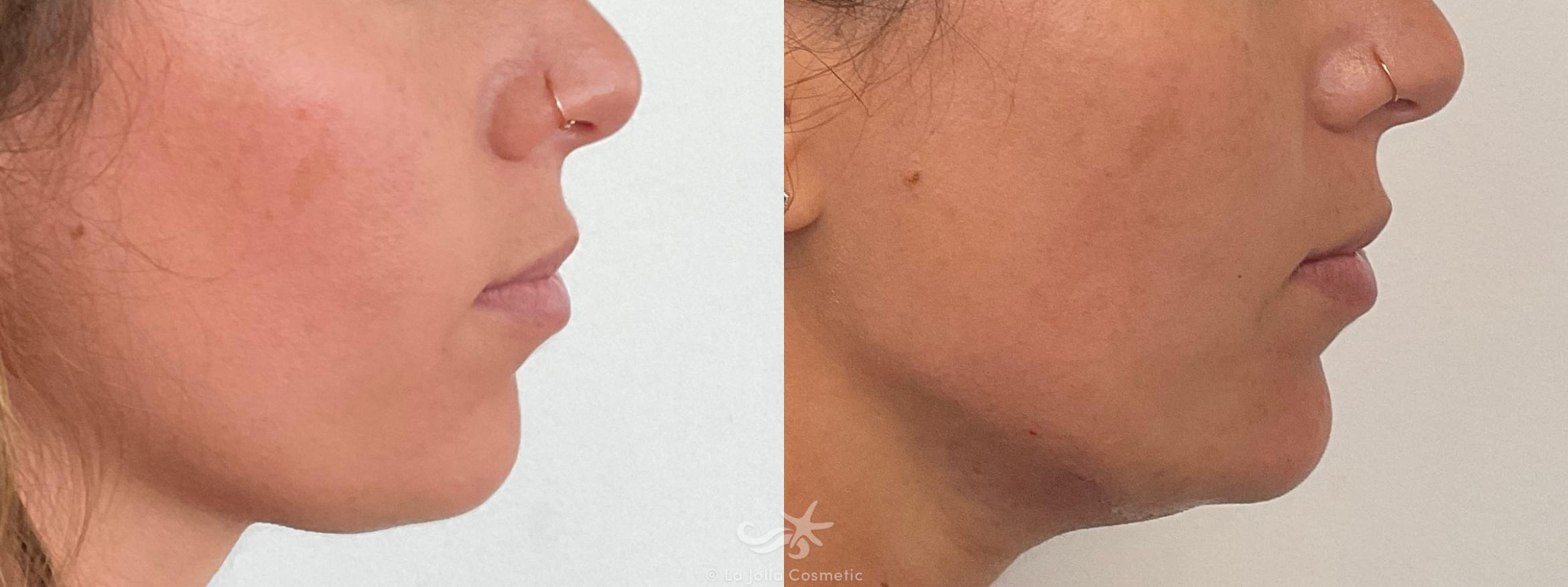 Before & After Juvéderm® Voluma™ Result 694 Right Side View in San Diego, CA