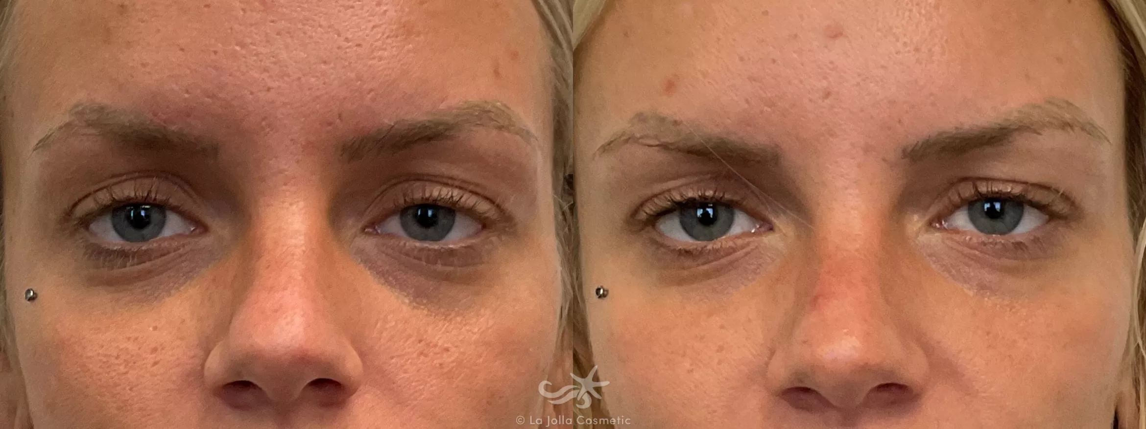 Before & After Juvéderm® Voluma™ Result 697 Front View in San Diego, CA