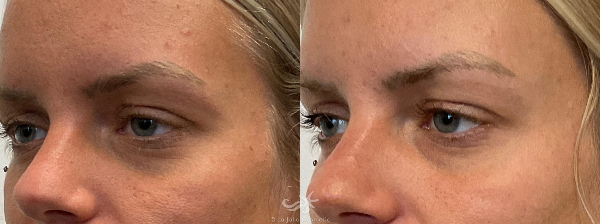 Before & After Juvéderm® Voluma™ Result 697 Right Oblique View in San Diego, CA