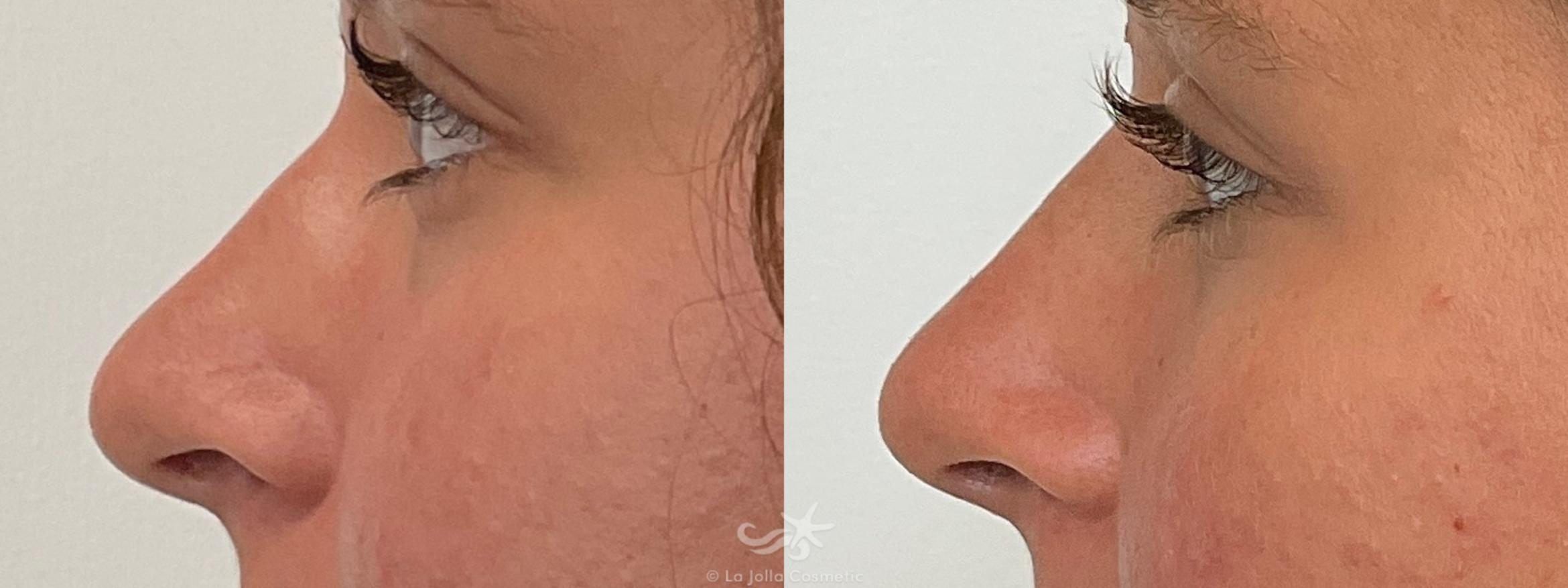 Before & After Juvéderm® Voluma™ Result 699 Left Side View in San Diego, CA