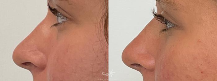 Before & After Juvéderm® Voluma™ Result 699 Left Side View in San Diego, Carlsbad, CA