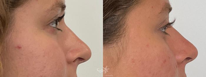 Before & After Juvéderm® Voluma™ Result 699 Right Side View in San Diego, Carlsbad, CA
