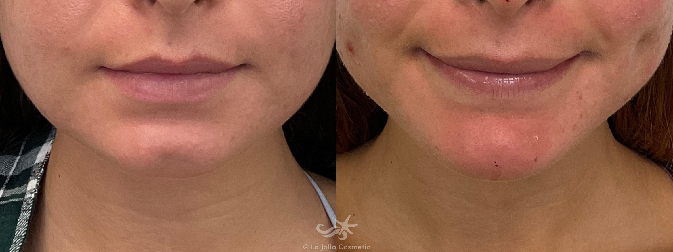 Before & After Juvéderm® Voluma™ Result 700 Front View in San Diego, CA