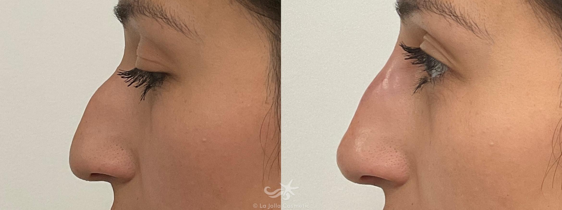 Before & After Juvéderm® Voluma™ Result 708 Left Side View in San Diego, CA