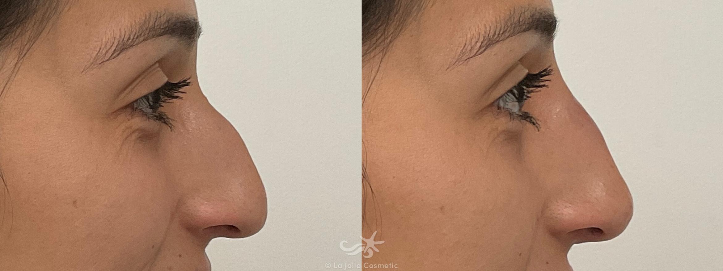 Before & After Juvéderm® Voluma™ Result 708 Right Side View in San Diego, CA