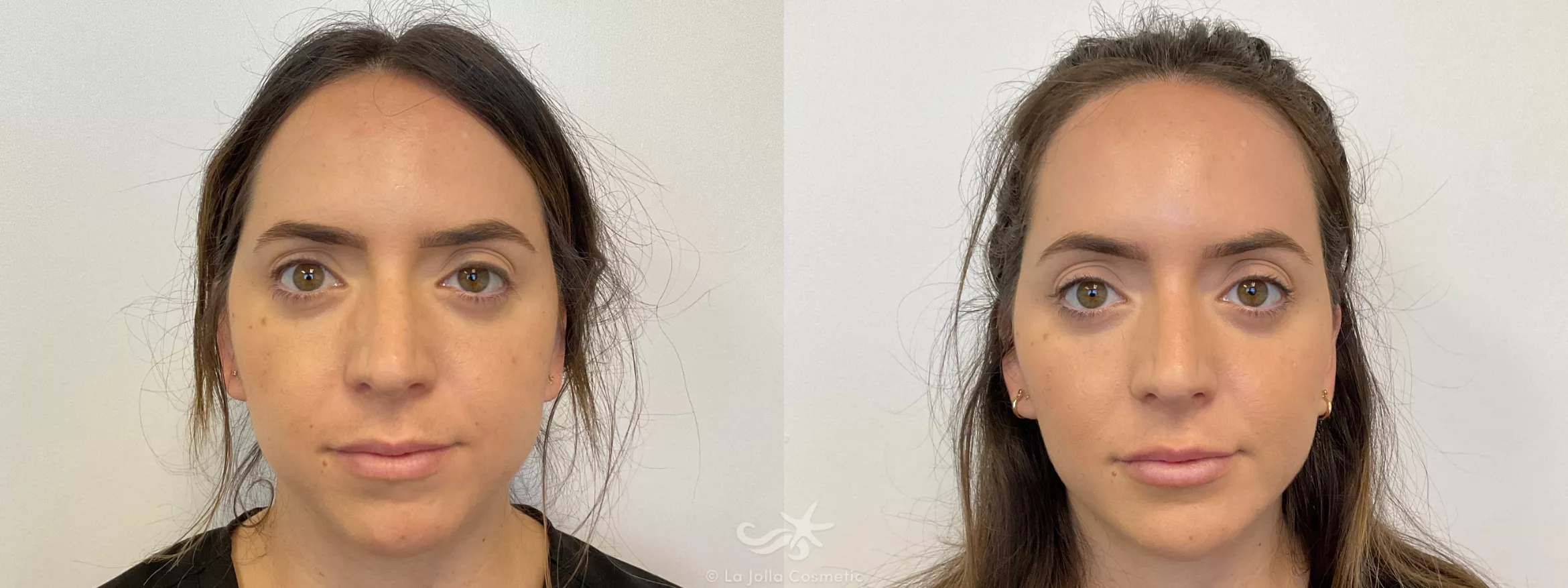 Before & After Juvéderm® Voluma™ Result 723 Front View in San Diego, CA