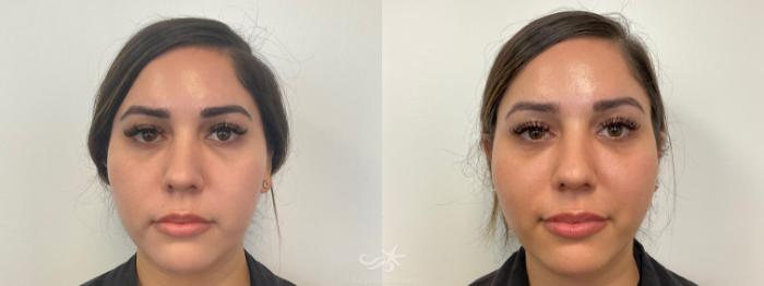 Before & After Juvéderm® Voluma™ Result 766 Front View in San Diego, Carlsbad, CA