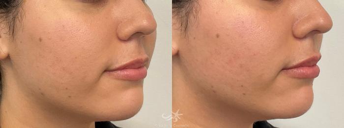 Before & After Juvéderm® Voluma™ Result 766 Right Oblique View in San Diego, Carlsbad, CA