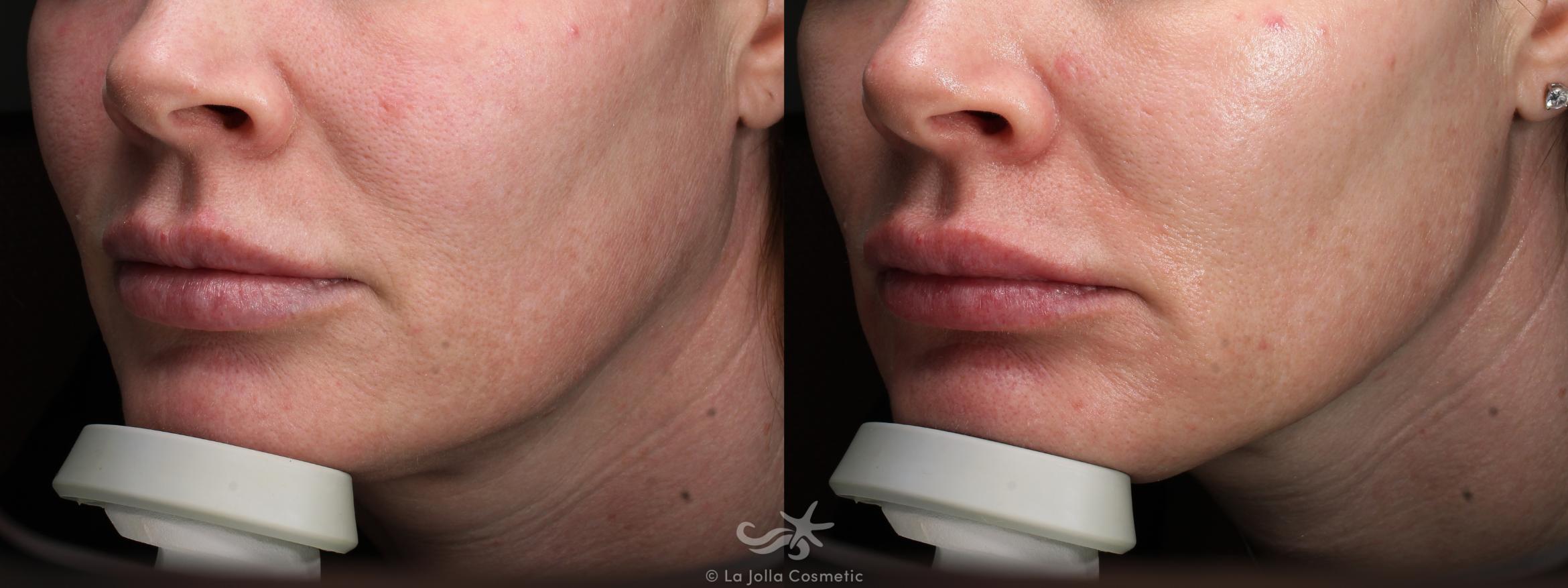 Before & After Juvéderm® Volux™ Result 762 Left Oblique View in San Diego, Carlsbad, CA