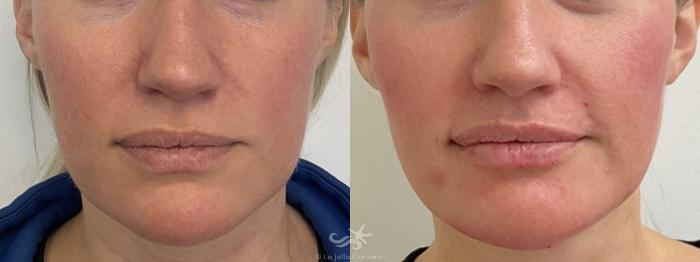 Before & After Juvéderm® Volux™ Result 767 Front View in San Diego, Carlsbad, CA