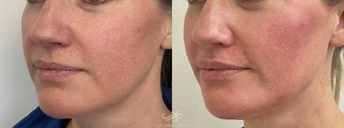 Before & After Juvéderm® Volux™ Result 767 Left Oblique View in San Diego, Carlsbad, CA