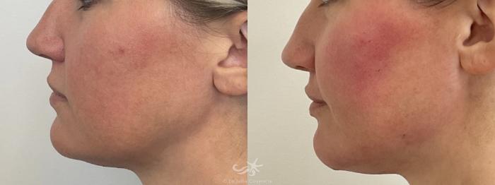 Before & After Juvéderm® Volux™ Result 767 Left Side View in San Diego, Carlsbad, CA