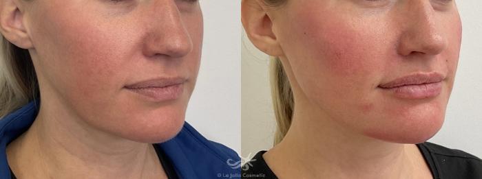Before & After Juvéderm® Volux™ Result 767 Right Oblique View in San Diego, Carlsbad, CA