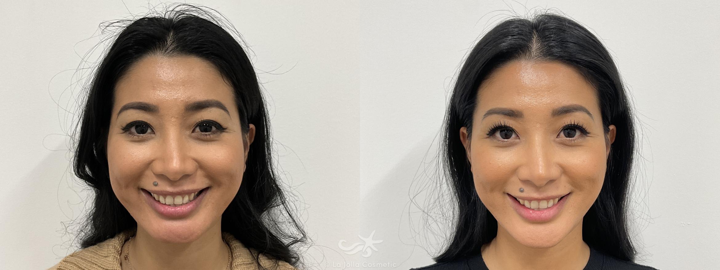 Before & After Juvéderm® Volux™ Result 810 Front View in San Diego, Carlsbad, CA