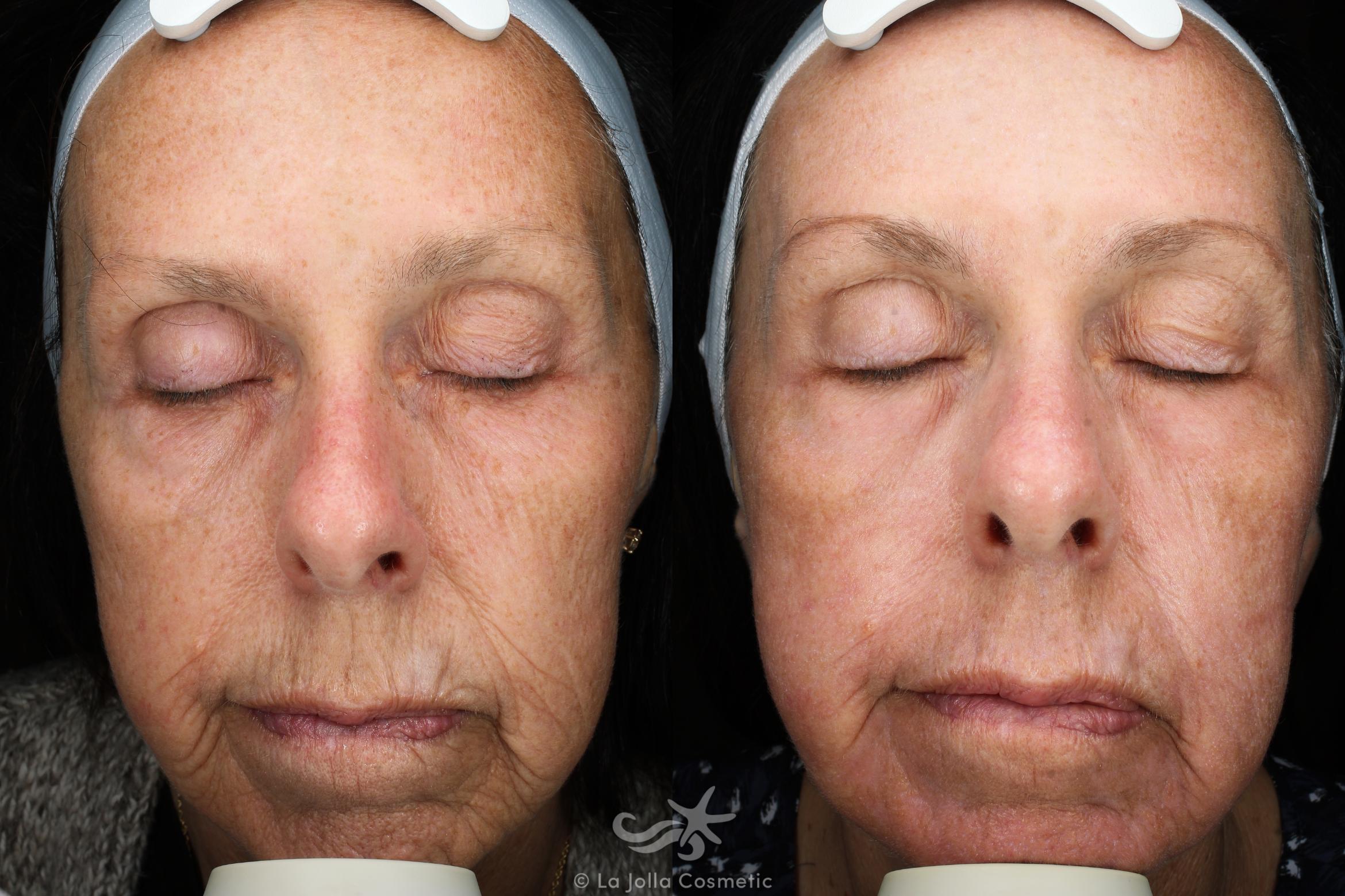 Before & After Laser Treatments Result 115 Front View in San Diego, CA