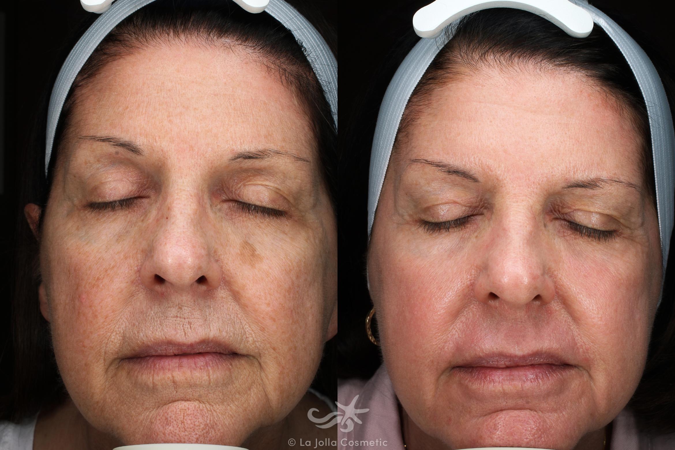 Before & After HALO™ Laser Treatment Result 116 Front View in San Diego, CA