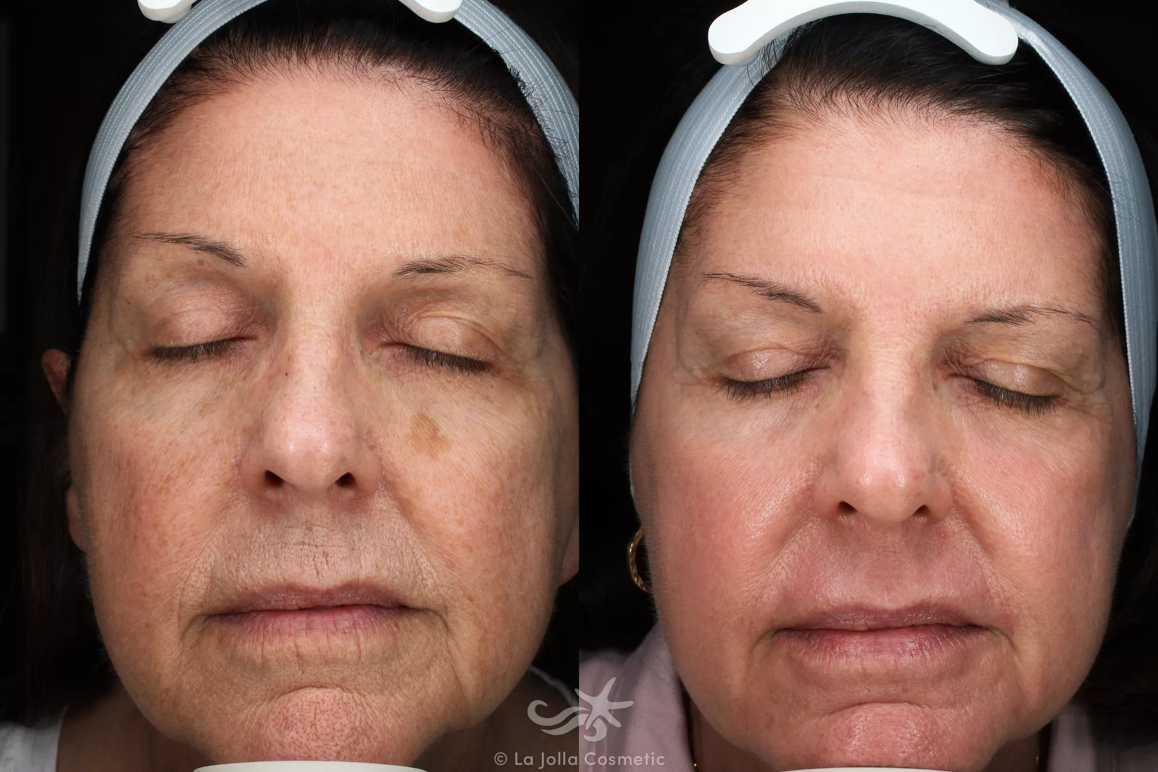 Before & After Laser Treatments Result 116 Front View in San Diego, CA