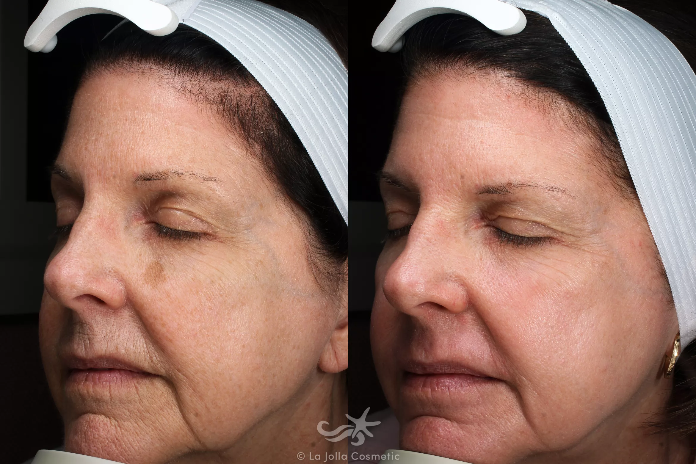 Before & After Laser Treatments Result 116 Left Oblique View in San Diego, CA