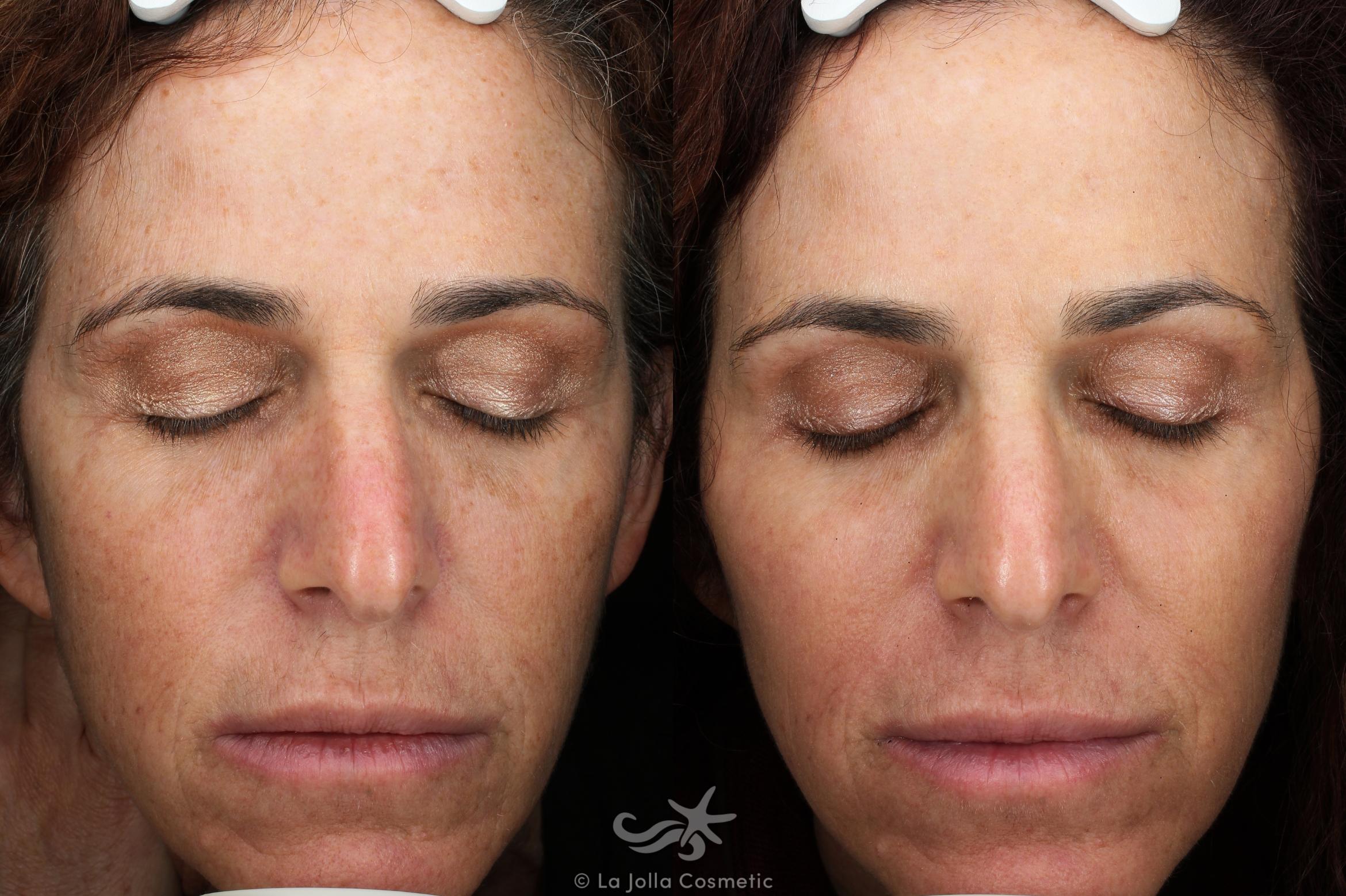 Before & After Laser Treatments Result 117 Front View in San Diego, CA