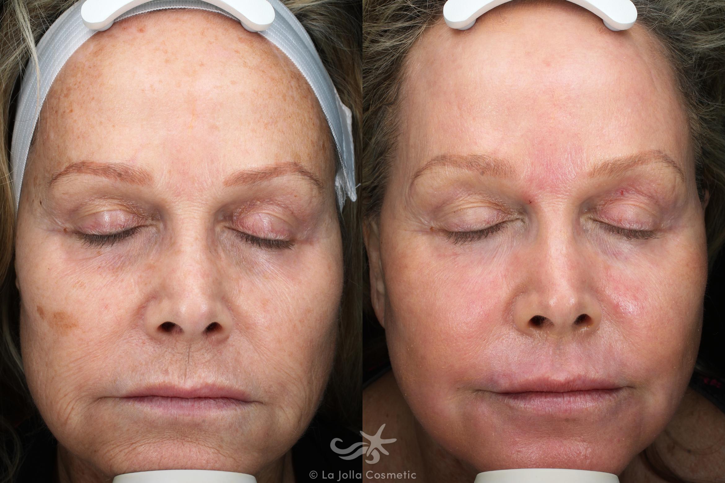 Before & After Laser Treatments Result 120 Front View in San Diego, CA