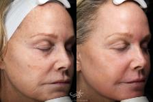 Before & After Laser Treatments Result 120 Right Oblique View in San Diego, Carlsbad, CA