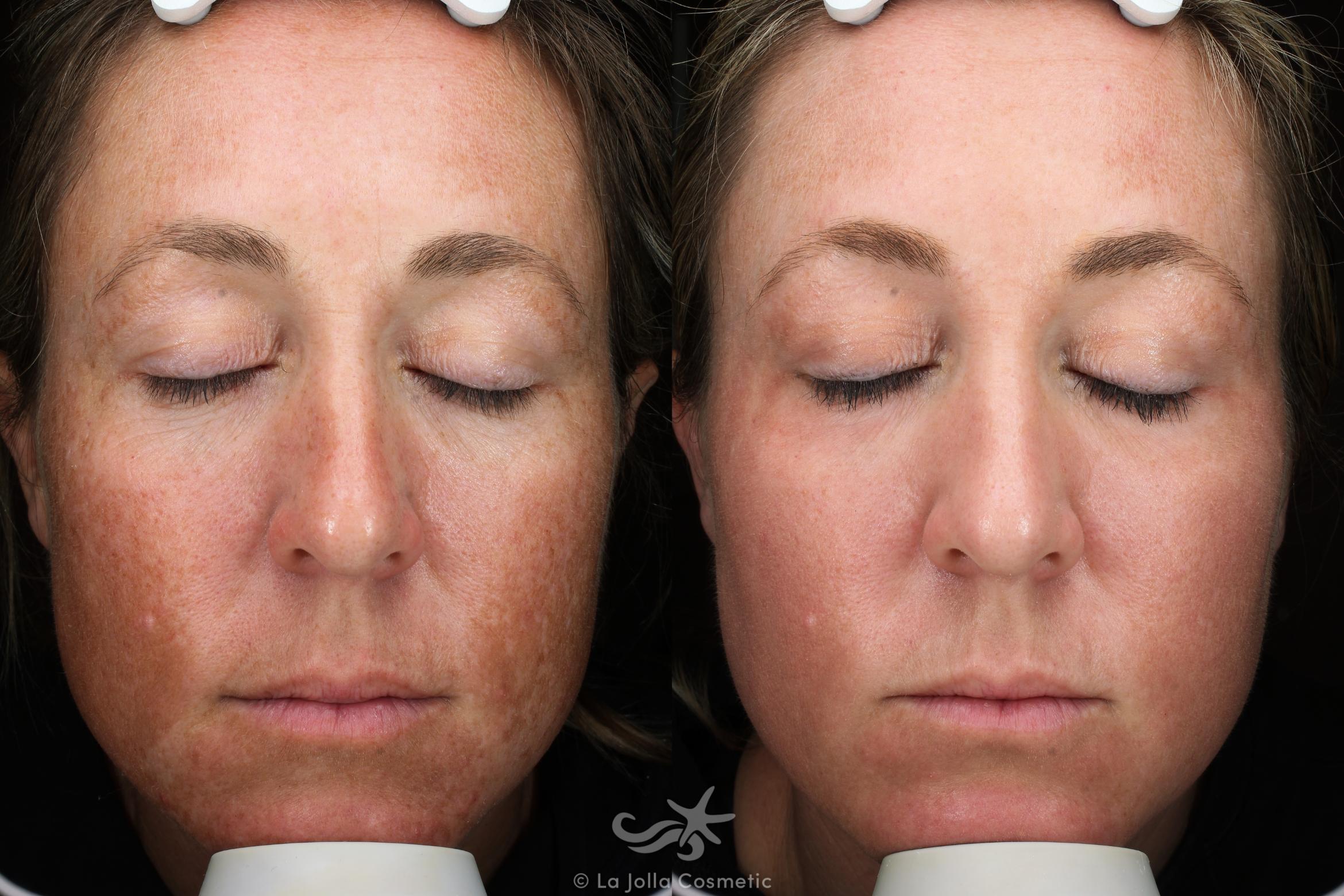 Before & After Laser Treatments Result 129 Front View in San Diego, CA