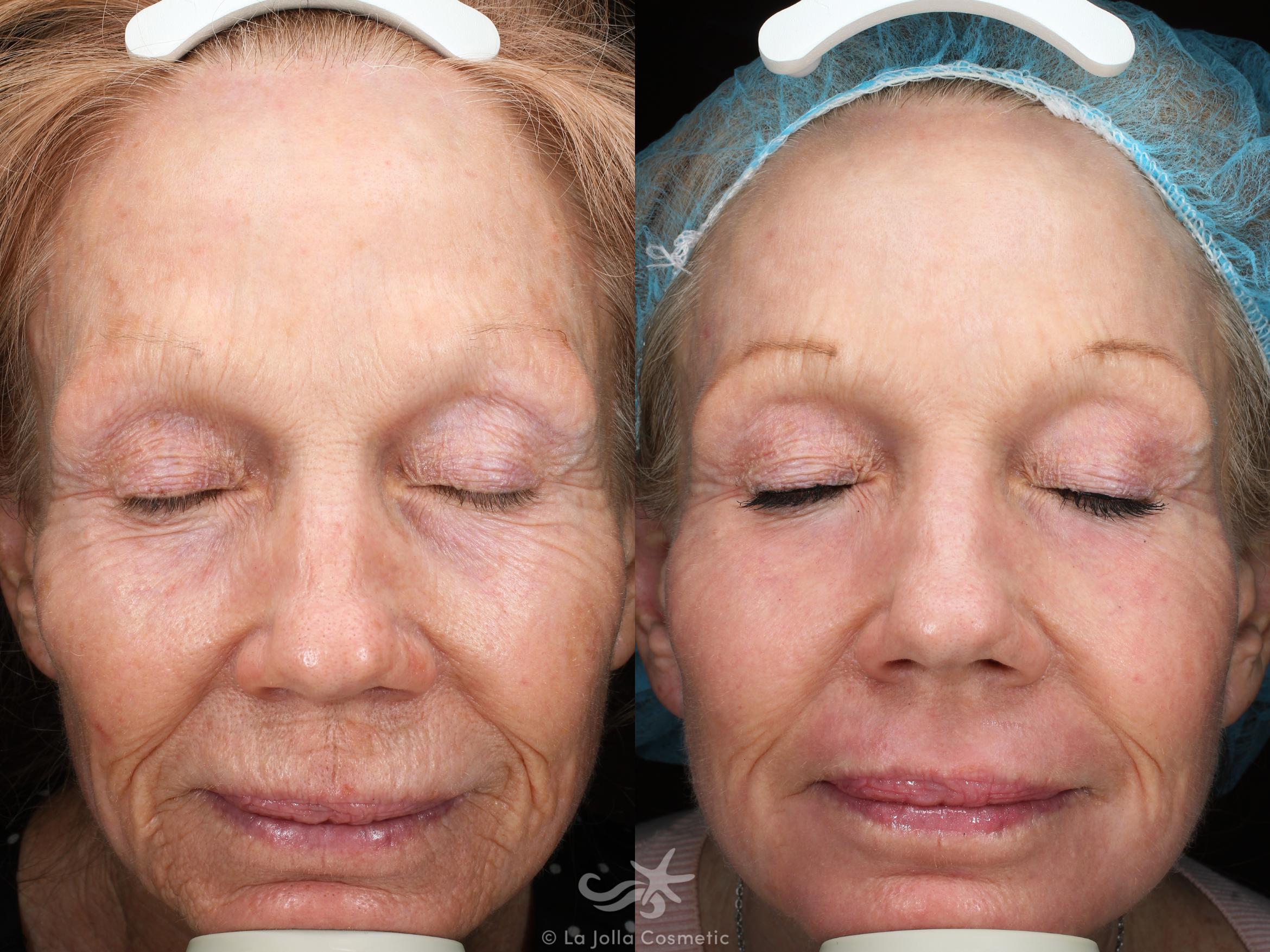 Before & After Laser Treatments Result 52 Front View in San Diego, CA