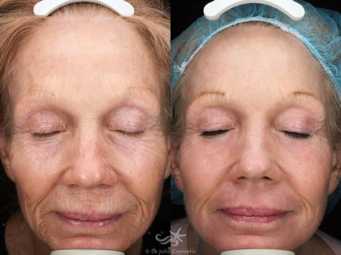 Before & After HALO™ Laser Treatment Result 52 Front View in San Diego, Carlsbad, CA