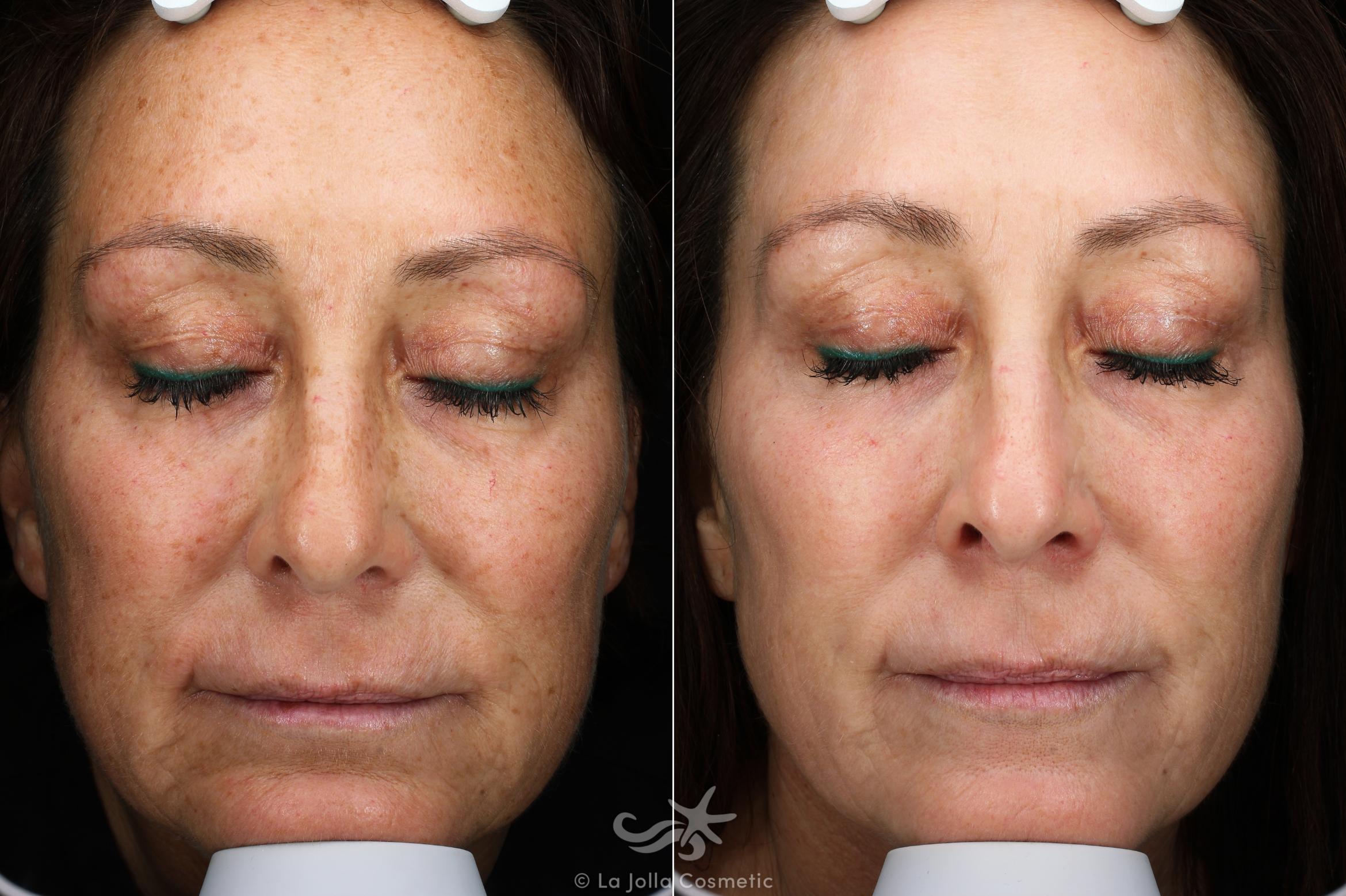 Before & After Laser Treatments Result 536 Front View in San Diego, CA