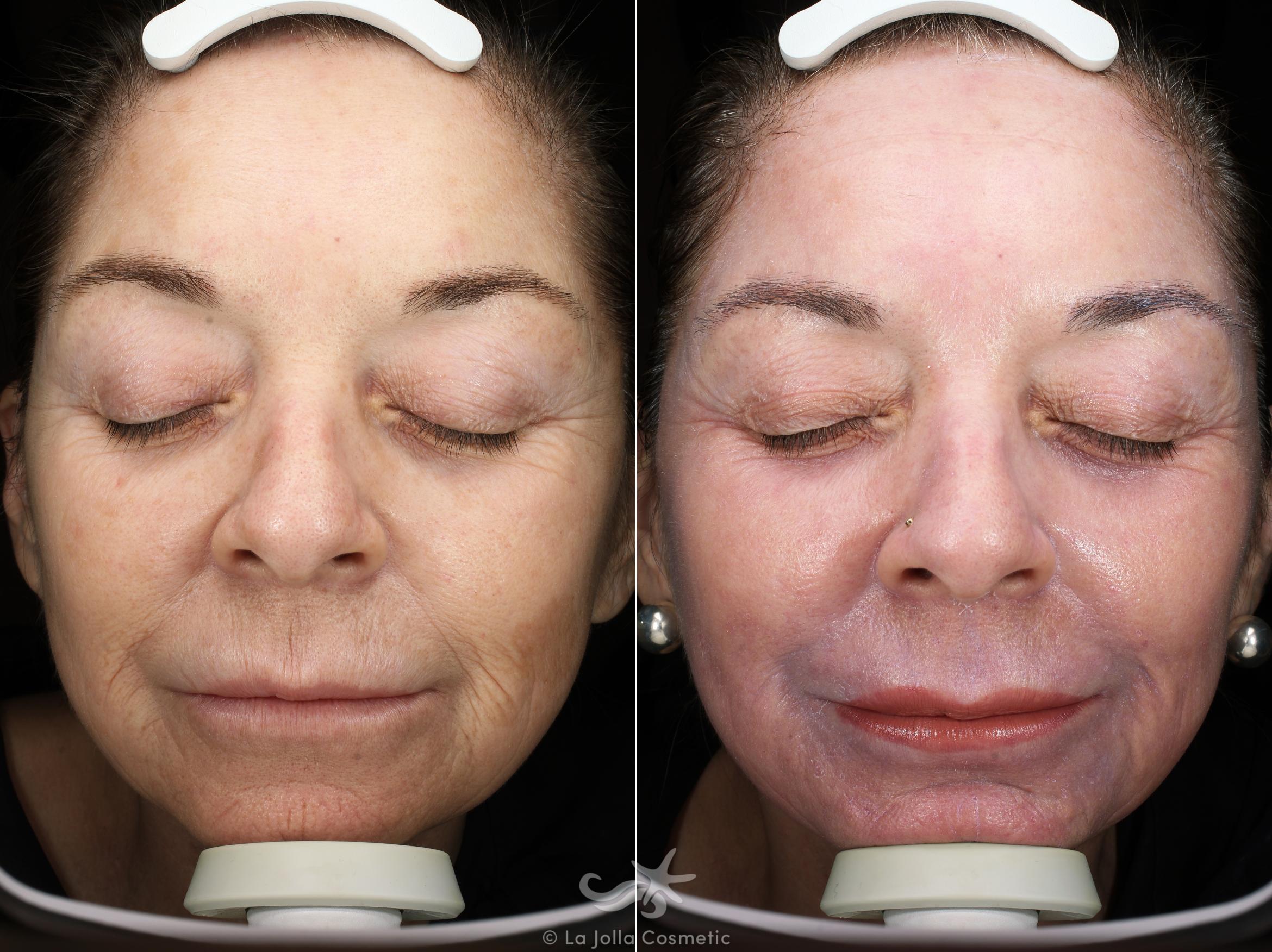 Before & After Laser Treatments Result 543 Front View in San Diego, CA