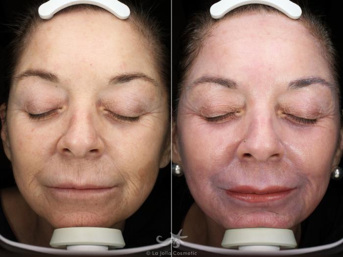 Before & After Laser Treatments Result 543 Front View in San Diego, Carlsbad, CA