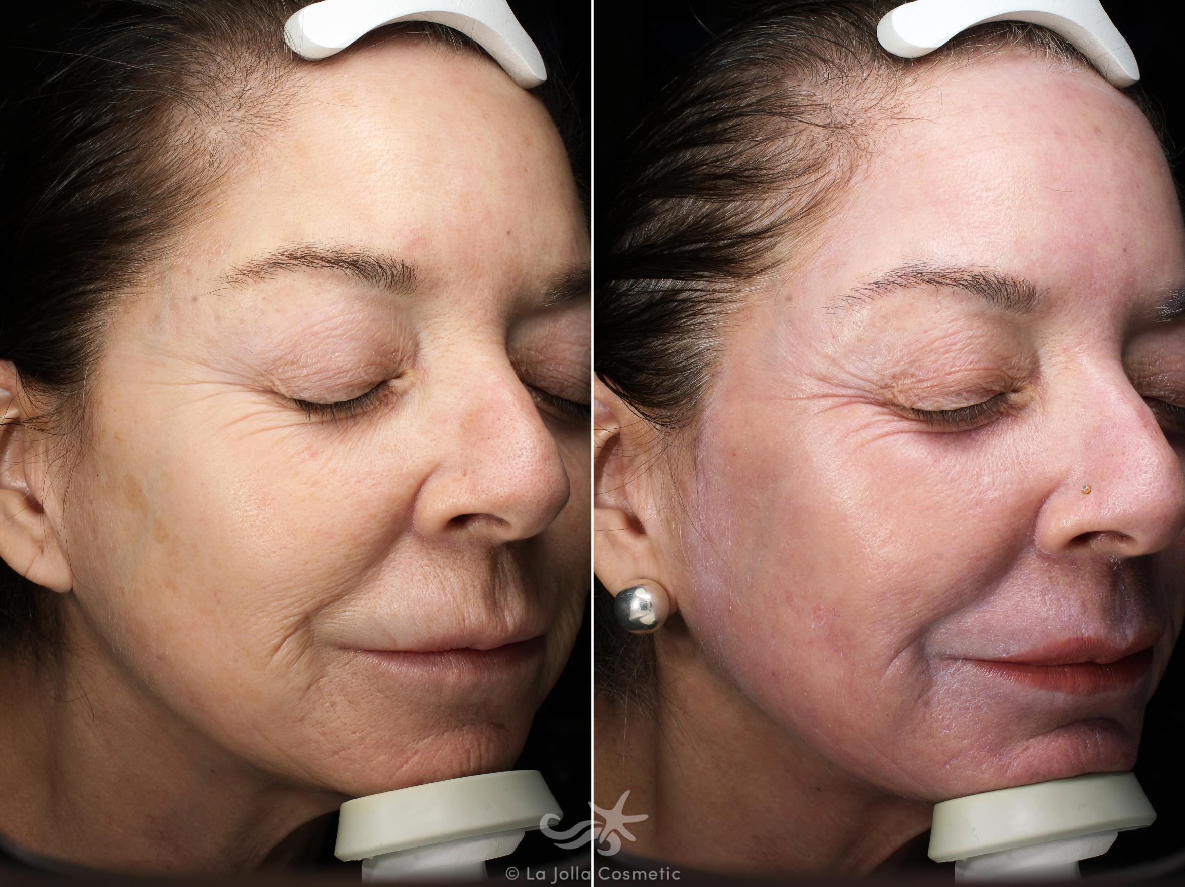 Before & After Laser Treatments Result 543 Right Side View in San Diego, CA