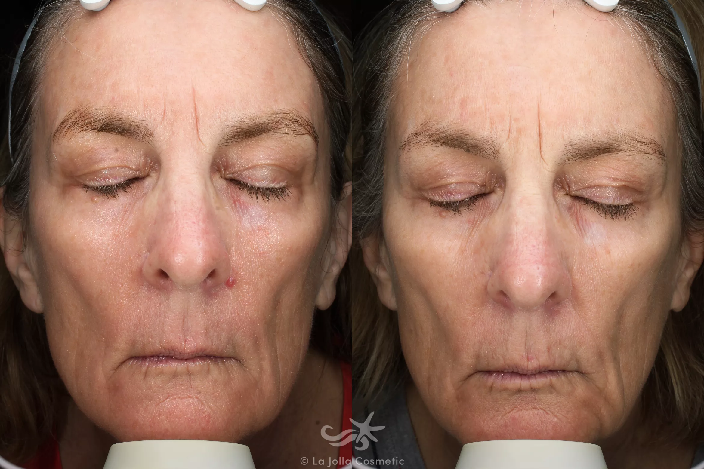 Before & After Laser Treatments Result 544 Front View in San Diego, CA