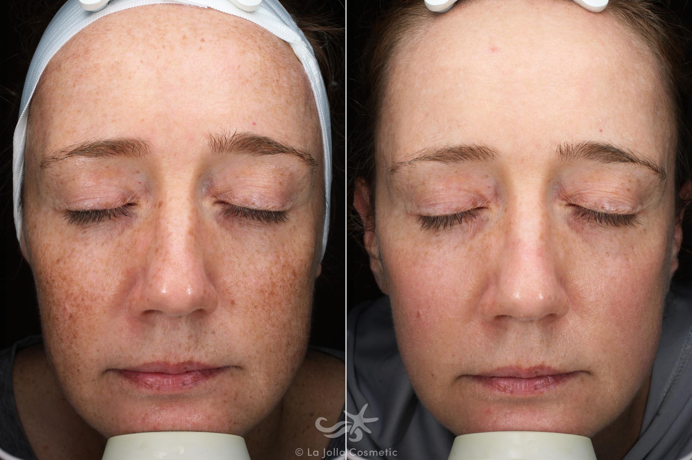 Before & After Laser Treatments Result 596 Front View in San Diego, CA