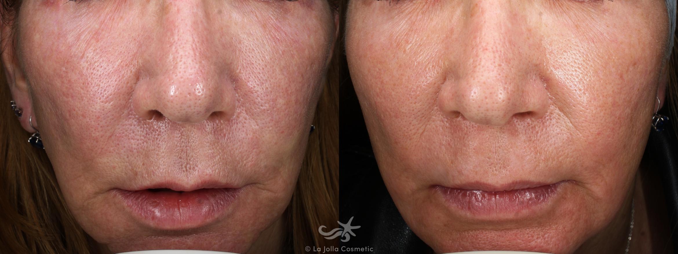 Before & After Laser Treatments Result 673 Front View in San Diego, CA