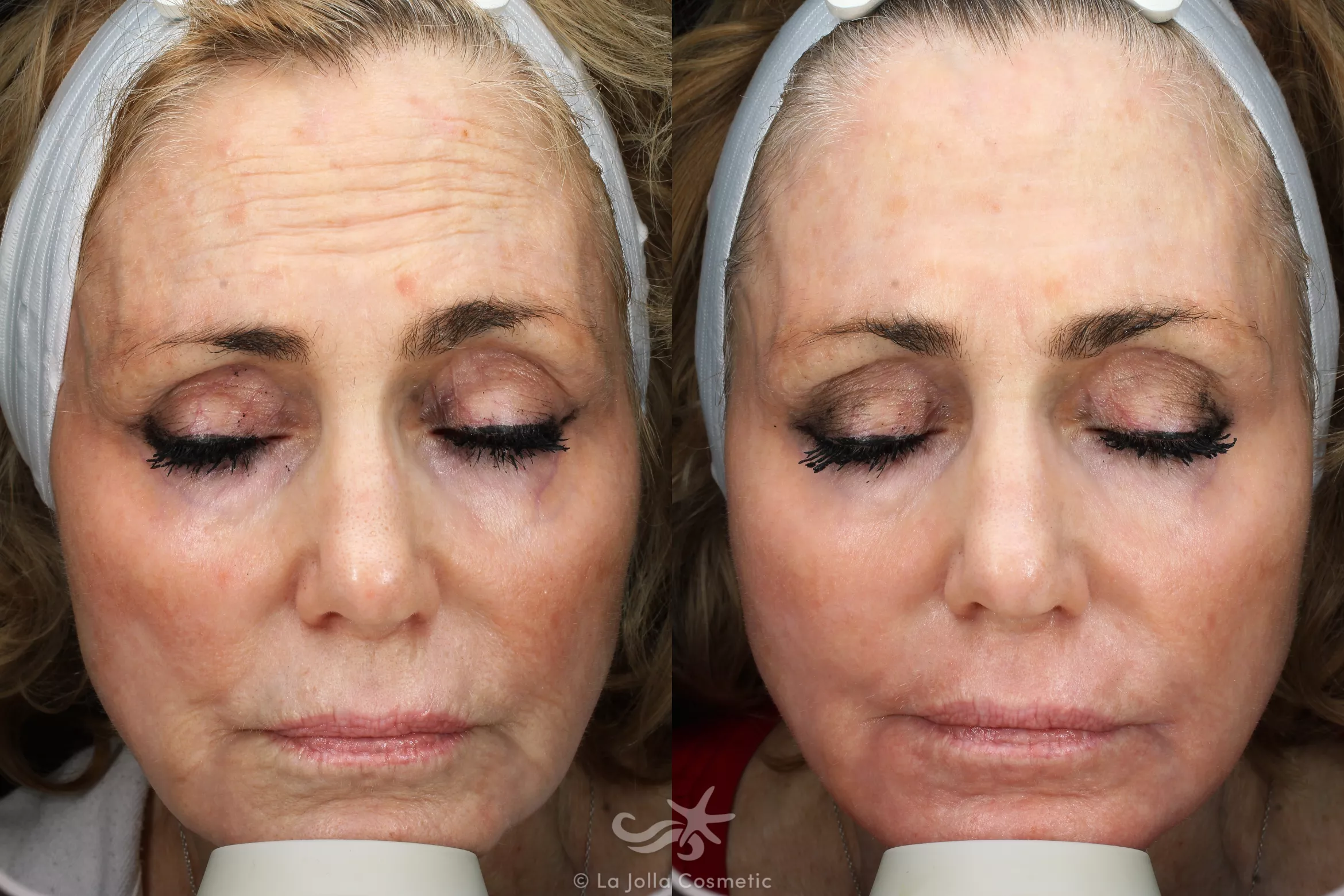 Before & After Laser Treatments Result 677 Front View in San Diego, CA