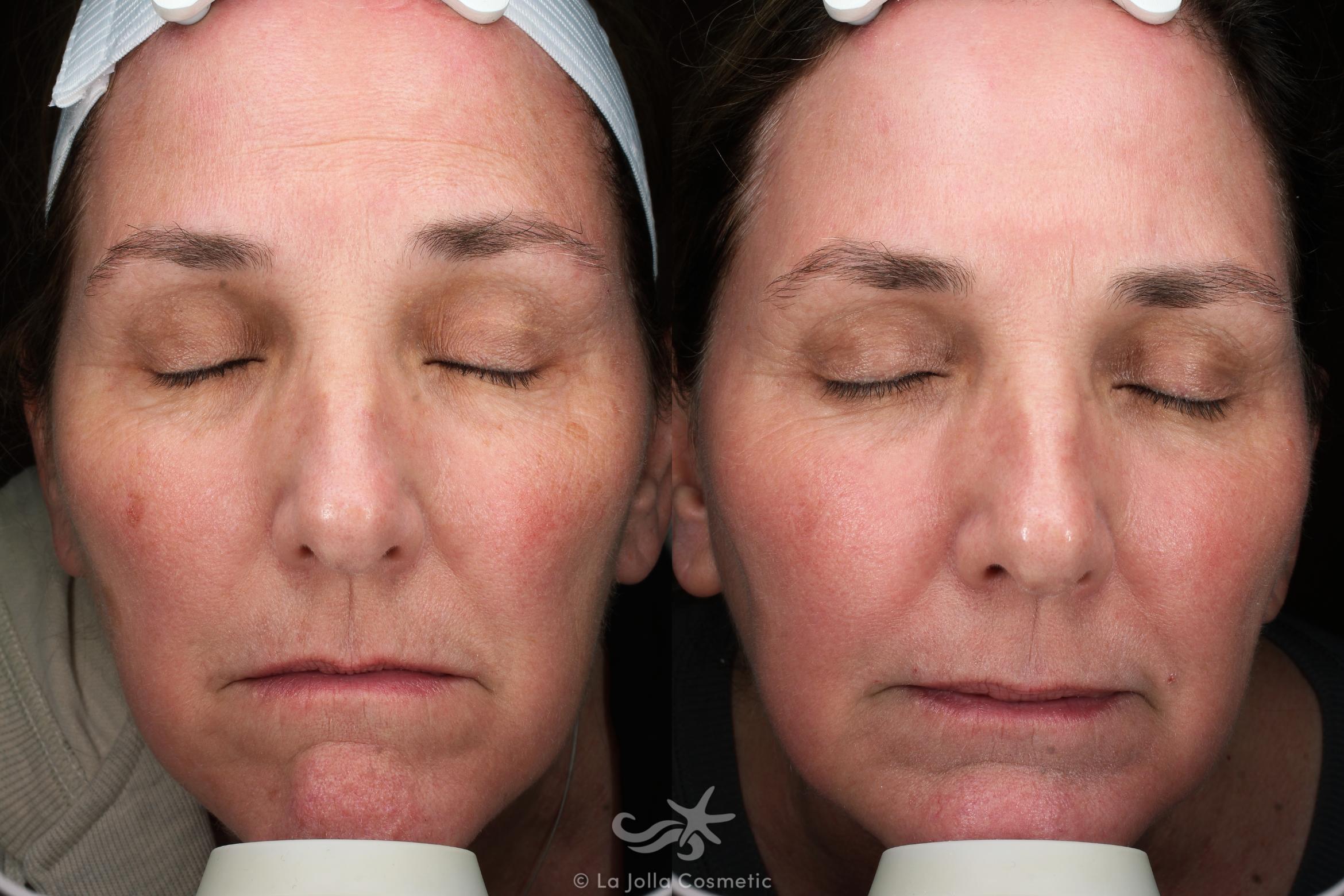 Before & After HALO™ Laser Treatment Result 678 Front View in San Diego, CA