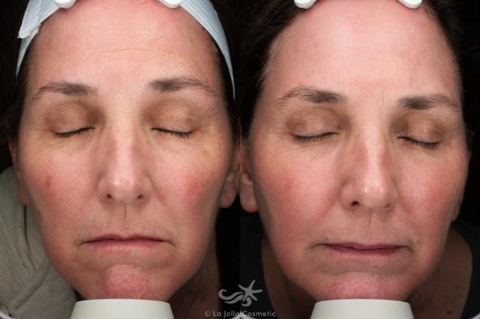 Before & After Laser Treatments Result 678 Front View in San Diego, Carlsbad, CA