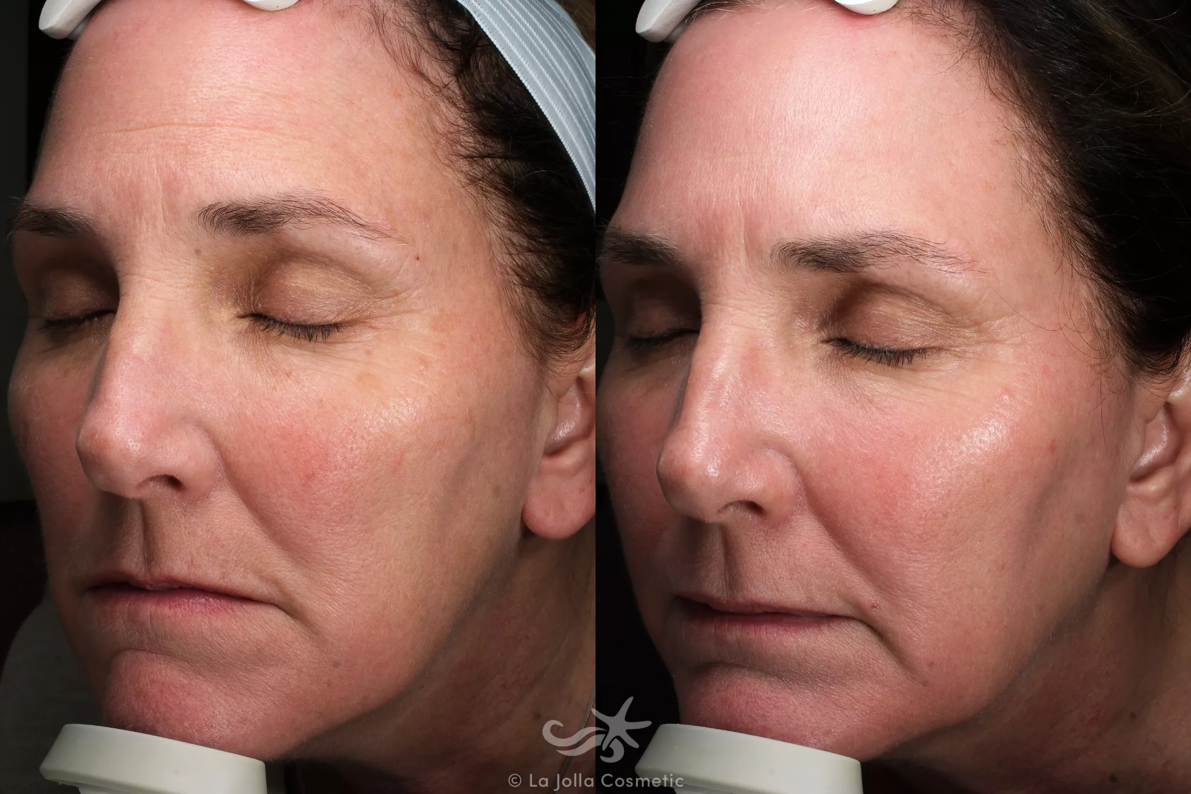 Before & After Laser Treatments Result 678 Left Oblique View in San Diego, CA