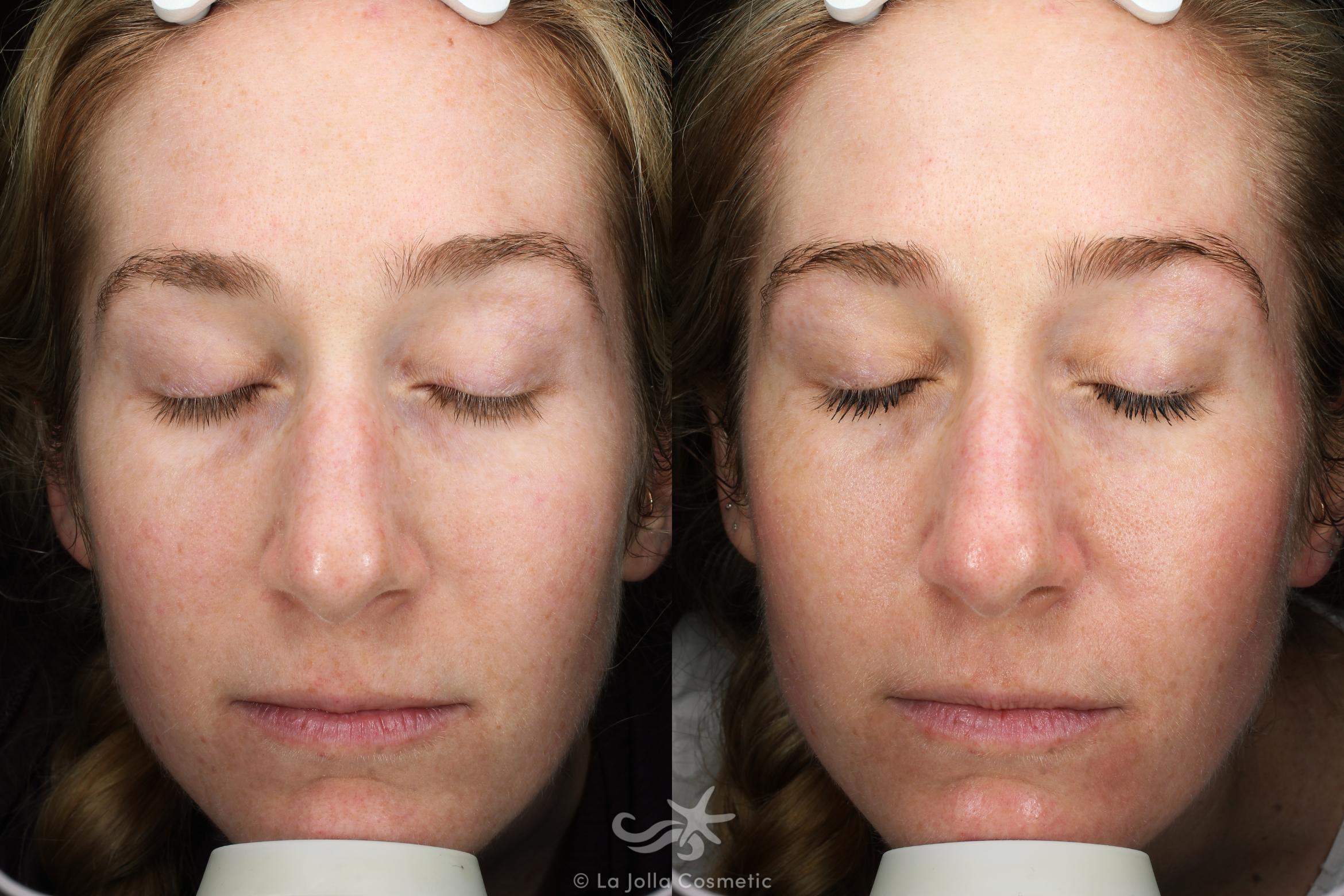 Before & After Laser Treatments Result 679 Front View in San Diego, CA