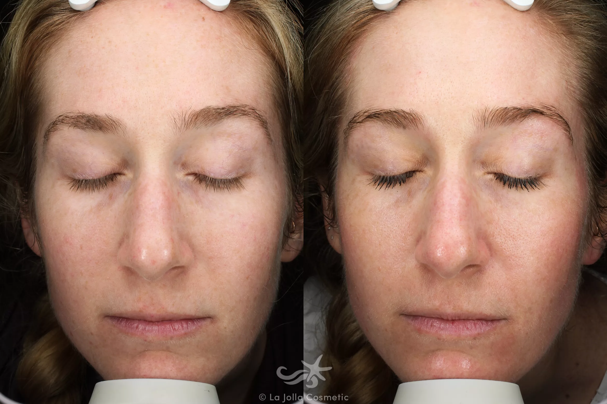 Before & After Laser Treatments Result 679 Front View in San Diego, CA