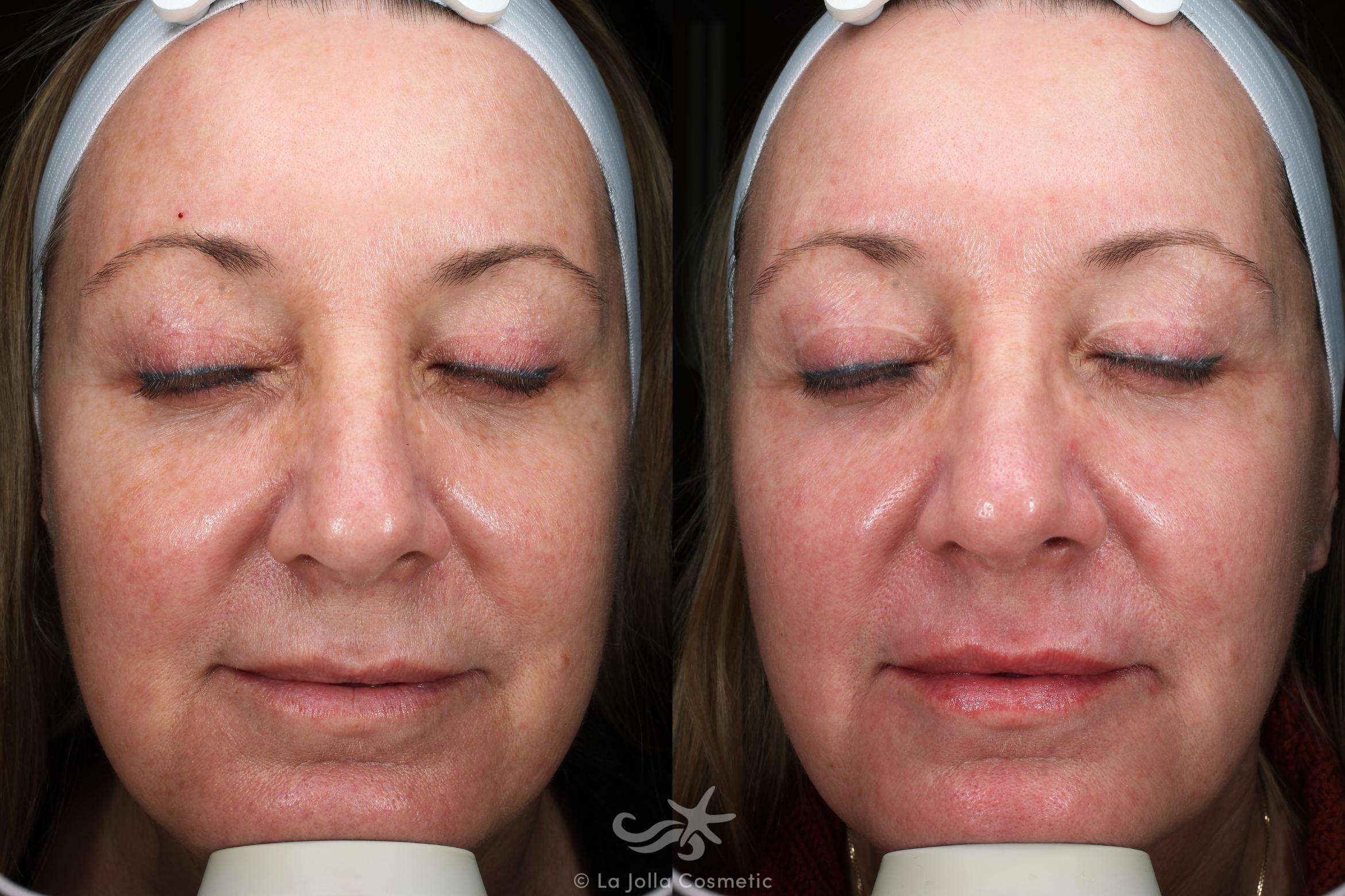 Before & After Laser Treatments Result 692 Front View in San Diego, CA