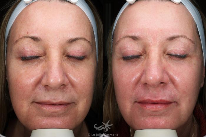 Before & After Laser Treatments Result 692 Front View in San Diego, Carlsbad, CA