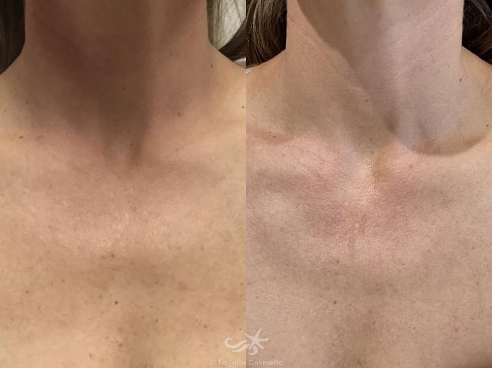 Before & After Laser Treatments Result 765 Front View in San Diego, Carlsbad, CA