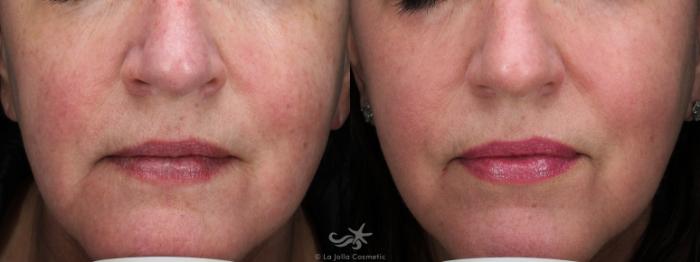 Before & After Laser Treatments Result 775 Front View in San Diego, Carlsbad, CA