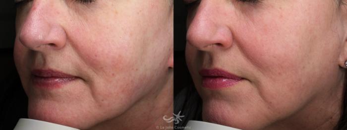 Before & After Laser Treatments Result 775 Left Oblique View in San Diego, Carlsbad, CA