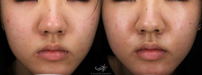 Before & After Laser Treatments Result 776 Front View in San Diego, Carlsbad, CA