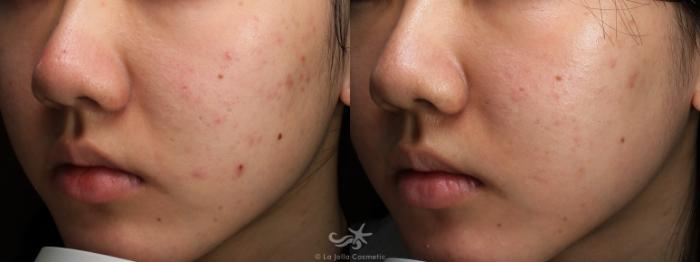 Before & After Laser Treatments Result 776 Left Oblique View in San Diego, Carlsbad, CA