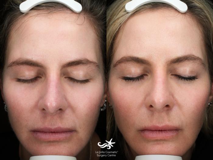 Before & After Laser Treatments Result 850 Front View in San Diego, Carlsbad, CA